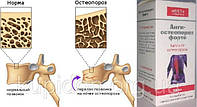 Анти-остеопороз Форте капли от остеопороза суставов, от артита, артроза, остеохондроза, ревматизма, полиартрит