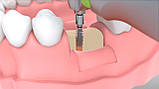 Фізіодиспенсер ImplantMED Si-1023 (W&H Dentalwerk,Австрія), фото 4