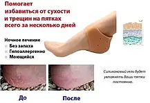 Силіконовий фіксатор для п'ят EL-1115 Heel anti-crack sets від мозолів і тріщин, Нап'яточник, фото 6