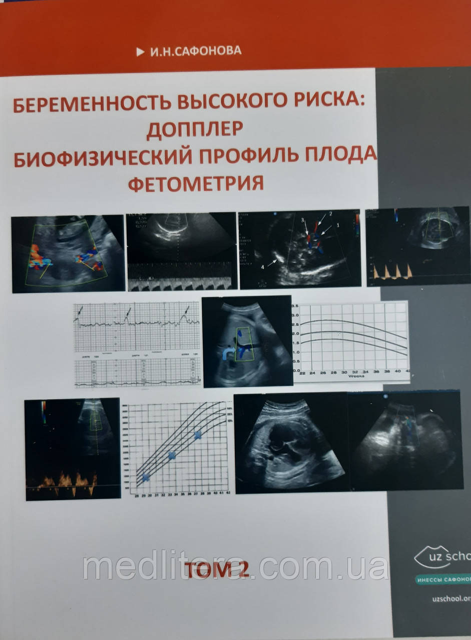 Сафонова. І. М. Вагітність високого ризику. Доплер. Біофізичний профіль плода. Фетометрія том 2.