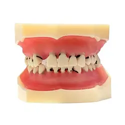 Модель демонстраційна з пародонтологічними патологіями та вісімкою HST-L4