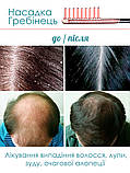 Лікування випадіння волосся та лупи Дарсонваль  MEDICA+ Darsoline 7.0 Японія, фото 4