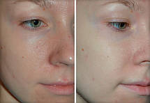 Мезоролер Derma Roller для волосся (шкіри голови) 1 мм, 540 голок, фото 3