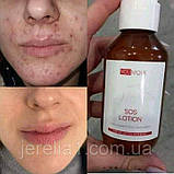 Локальний SOS- лосьйон (Бовтушка) АнтиАкне, 100 мл, фото 8
