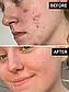 Точковий засіб від висипаньThe INKEY List Succinic Acid Blemish Treatment, фото 5