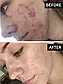 Точковий засіб від висипаньThe INKEY List Succinic Acid Blemish Treatment, фото 4
