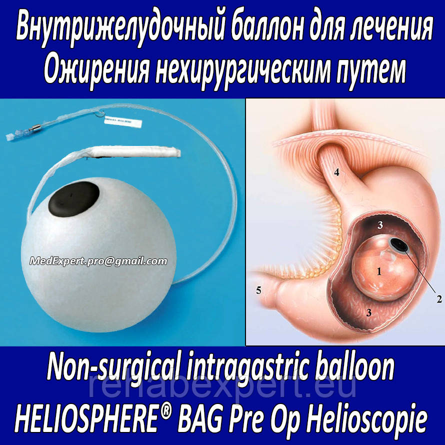 баллонирование желудка для похудения. рукавная гастропластика. бариатрическая операция баллон. баллон в желудок для похудения. Weight loss balloon.