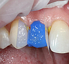 Травильний гель Ultra-Etch 30мл (Ultradent), фото 4