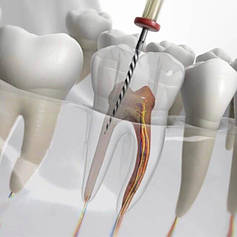 Інструменти для оброблення кореневих каналів
