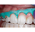 OpalDam Green,ОпалДам,шпр. 1.2мл, колір: зелений з блискітками (Ultradent), фото 3