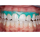 OpalDam Green,ОпалДам,шпр. 1.2мл, колір: зелений з блискітками (Ultradent), фото 2