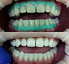 OpalDam Green,ОпалДам,шпр. 1.2мл, колір: зелений з блискітками (Ultradent), фото 4