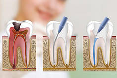 Матеріали для пломбування кореневих каналів