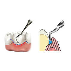 Ретракційні нитки