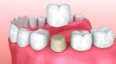 Тимчасова пластмаса