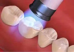 Фотополімери для реставрацій