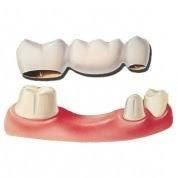 Фіксаційні цементи та склоіономерні матеріали