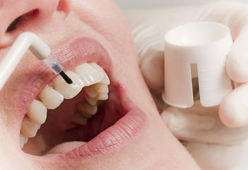 Фтор лак | Ремініралізація