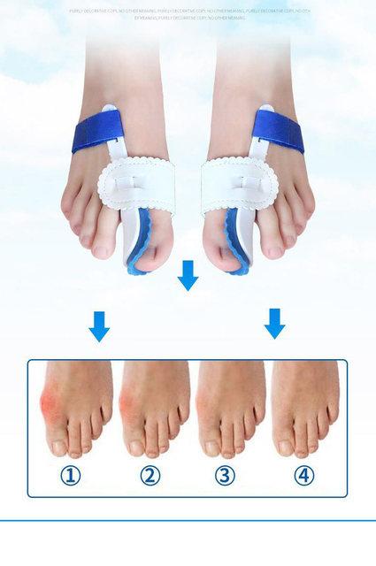 Розділювач пальців при вальгусній деформації пальців ніг