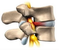 Безопераційне лікування міжхребцевої грижі