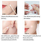 Уценка! Патчі від прищів Sersanlove ACNE PATCH (екстракт чайного дерева) 72 штуки (м'ята коробка), фото 2