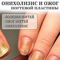 Вебинар 3 в 1 БОЛЕЗНИ НОГТЕЙ + ОНИХОЛИЗИС + ОЖОГИ НОГТЕВОЙ ПЛАСТИНЫ