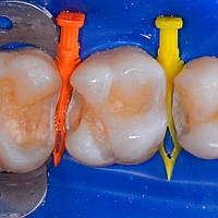 Клинья стоматологические пластиковые 3D 210 штук. разных размеров