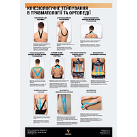Плакат "Кінезіотейпування в травматології" 30смх42см (1 плакат)