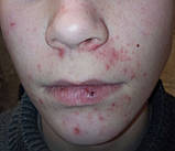 Сироватка анти-акне з рослинними екстрактами і азелаїновою кислотою, 30 мл, фото 8