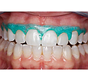 OpalDam Green,ОпалДам,шпр. 1.2мл, колір: зелений з блискітками (Ultradent), фото 3