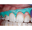 OpalDam Green,ОпалДам,шпр. 1.2мл, колір: зелений з блискітками (Ultradent), фото 4