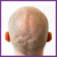 Підтримка при чутливості шкіри (грибок, псоріаз, бородавки...)