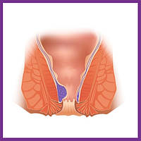 Засоби від геморою