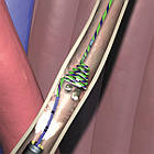 Нітіноловий екстрактор каменів Stone Cone, фото 2