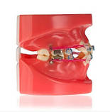 Модель демонстраційна ортодонтична з керамічними брекетами, фото 2