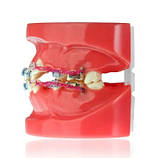 Модель демонстраційна ортодонтична з керамічними брекетами, фото 4
