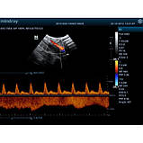 ЗІП апарат Z5-ультразвукова діагностична система з кольоровим доплером, фото 5