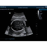 ЗІП апарат Z5-ультразвукова діагностична система з кольоровим доплером, фото 6