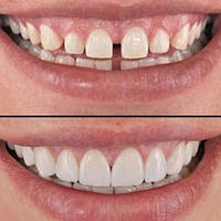 Виниры Съемные для Зубов Perfect Smile Veneers