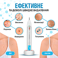 Електрокоагулятор плазмовий прилад для видалення папілом бородавок апарат Plasma Pen (плазмова ручка) XPREEN 051, фото 3