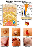 Плакат Бородавки і стрижнева мозоль розмір А2