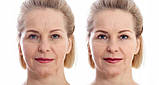 Апарат для мезотерапії Beautifly B-Glossy Pro, фото 3