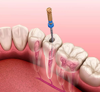 Матеріали і інструменти для ендодонтії