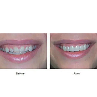 Съемные виниры Элайнеры Veneers Snap-on smile Накладные зубы с кейсом lux