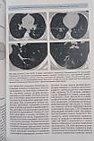 Китаєв В. М. Комп'ютерна томографія в пульмонології 2019 рік / КТ в пульмонології, фото 3