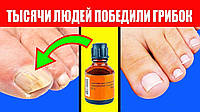Как вылечить грибок на ногтях ног? NormaDerm от грибка ногтей