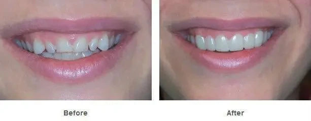 Съемные виниры элайнеры Veneers Snap-on smile | виниры для зубов | накладные зубы - фото 9 - id-p1283493602