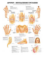 Плакат А3. Артрит - воспаление суставов