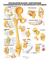 Плакат А3. Воспалительные нарушения тазобедренного и коленного суставов