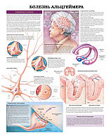 Плакат А3. Болезнь альцгеймера